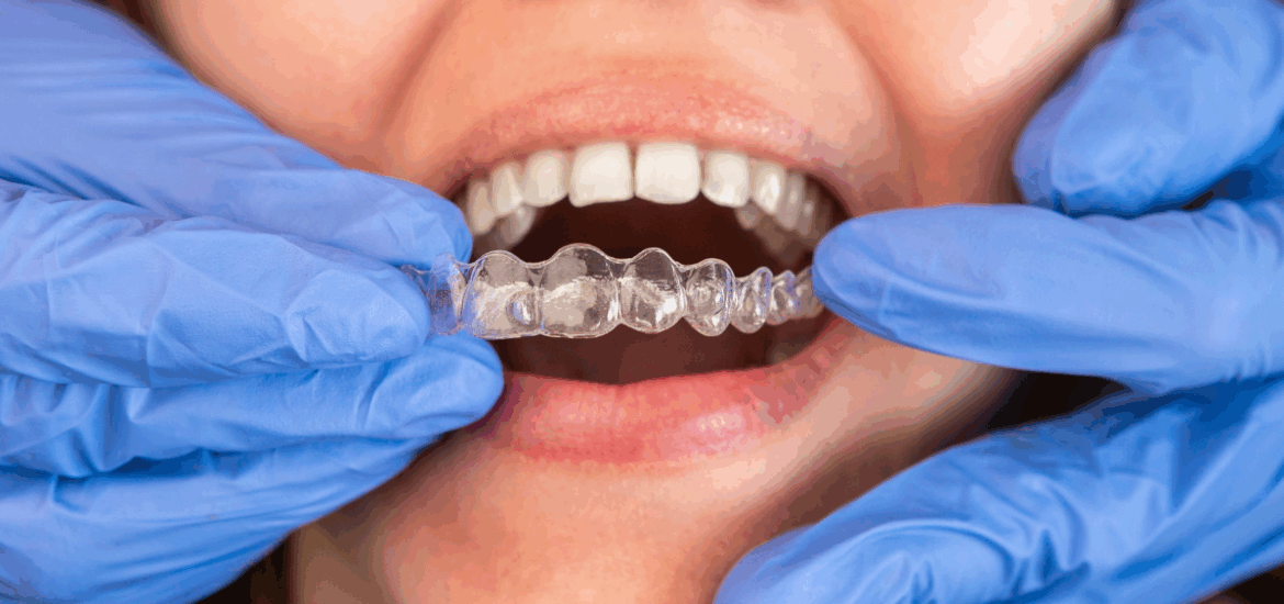 Invisalign Timeline for Adults