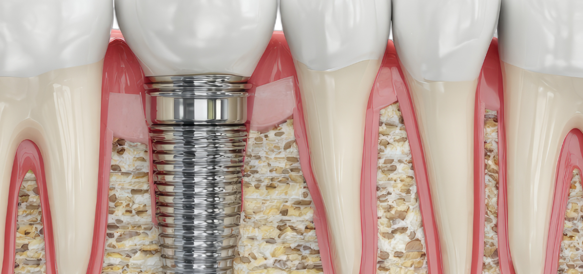 Dental Implant