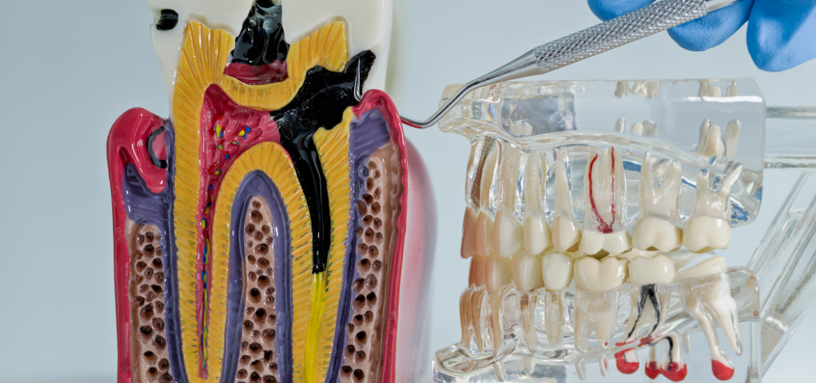 Root Canals