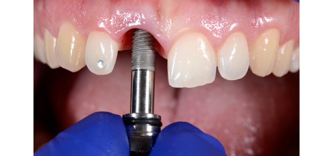 Dental Implants
