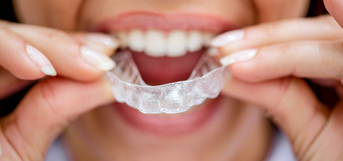Invisalign