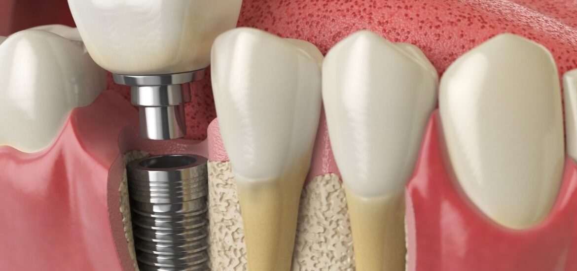 dental implants Scottsdale