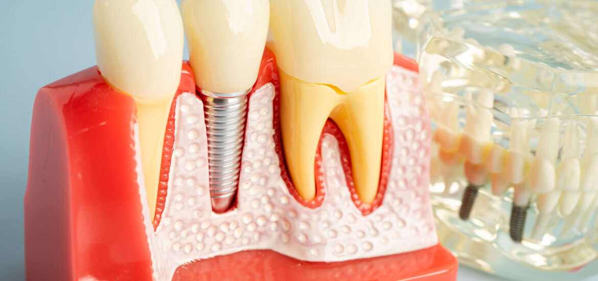 Dental Implants