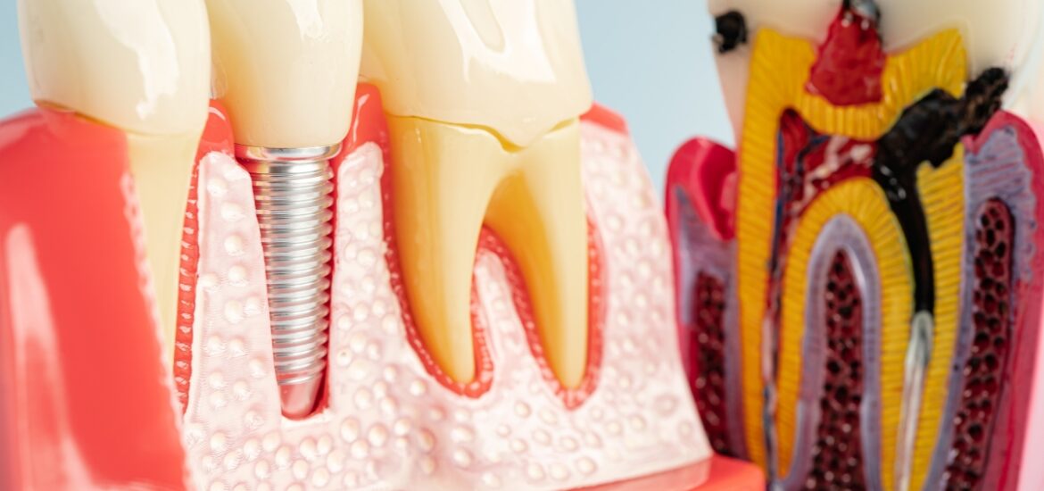 bone grafting before dental implants