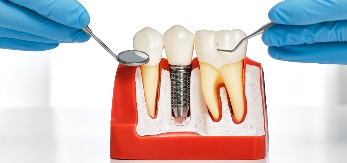 permanent tooth replacement