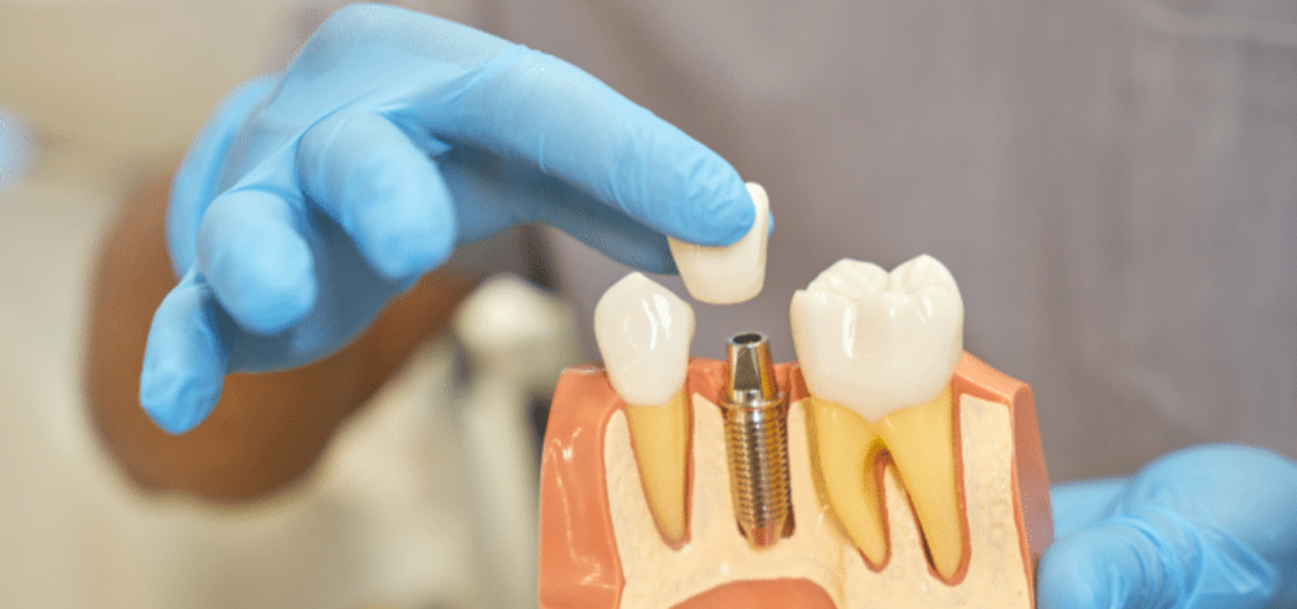 Dental Implants in Scottsdale