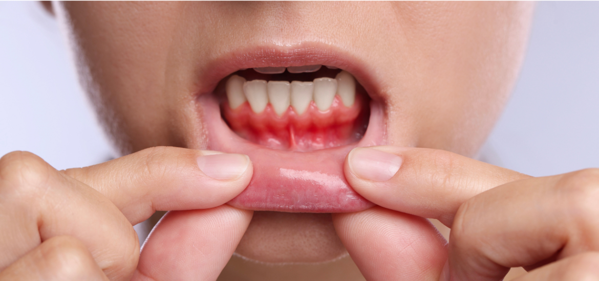 Pinhole Surgical Technique in Scottsdale