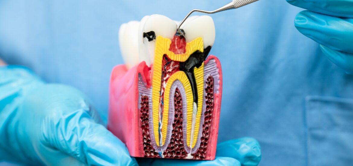 Dental model showing the stages of a root canal treatment