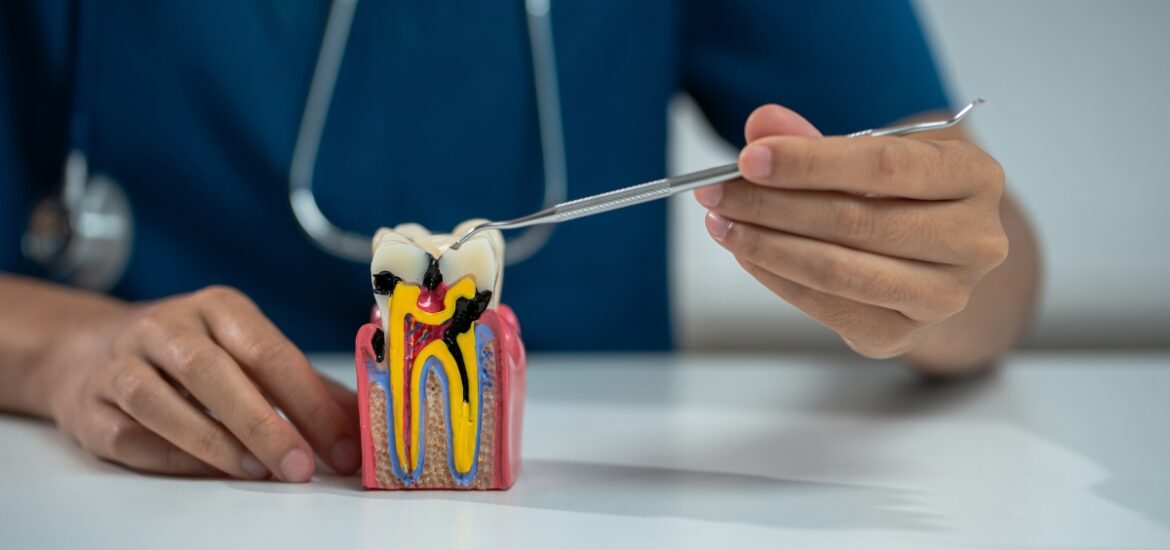 Dentist pointing at tooth model showing root canal treatment for dental problems